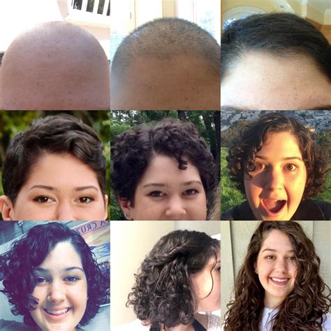 Discover More Than Hair Before And After Chemo Super Hot Ceg Edu Vn
