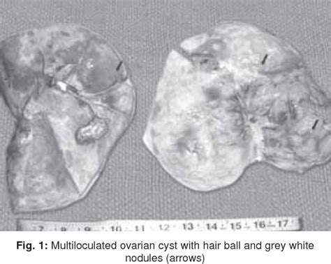 Figure From Squamous Cell Carcinoma Arising In Mature Cystic Teratoma