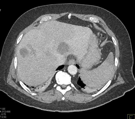 Gallbladder Cancer With Liver Metastases Liver Case Studies Ctisus