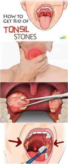 Palatine Tonsil Calcification Tonsil Pictures White Stones V Alert