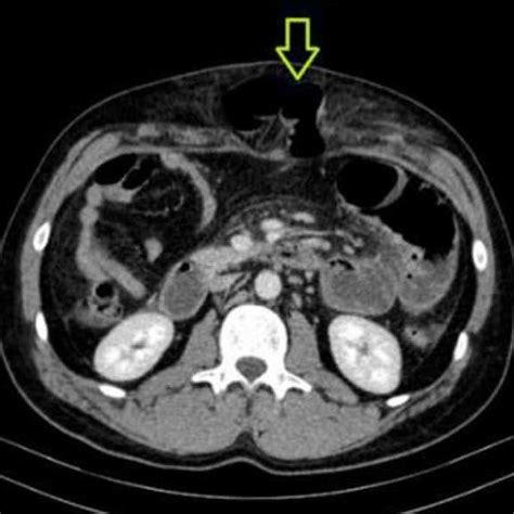 Ct Abdomen Showing Abdominal Wall Hernia Containing A Loop Of Small