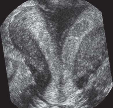 Three Dimensional Ultrasound Image Of A Didelphys Uterus Duplication