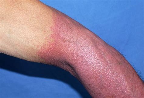 Pictures Of Photosensitivity Symptoms List Of Drugs