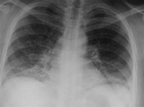 Pneumonia typically causes coughing and difficulty breathing. Pneumocystis carinii Pneumonia