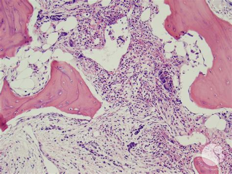Posted by gmill123 @gmill123, oct 14, 2020. Post-polycythemic myelofibrosis, bone marrow core 1