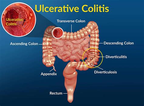 Ulcerative Colitis Stem Cells Offer Additional Treatment Option