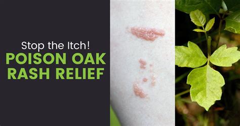 Poison Ivy Oak And Sumac Rash