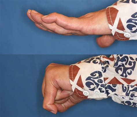 Swan Neck Deformity With 20° Of Pip Joint Hyperextension And Failure