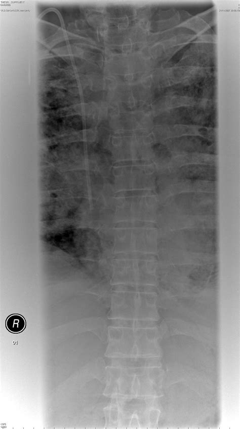 Ap Thoracic Spine Fine Focus Image Fig 6 Ap Thoracic Spine Broad