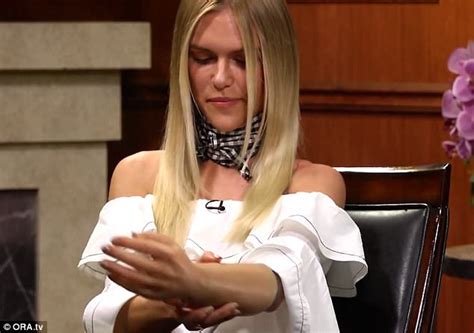 Lauren Scruggs Removes Prosthetic Arm For First Time On Tv Daily Mail