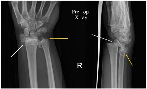 Cureus Combined Radial And Ulnar Epiphyseal Injury At The Wrist A