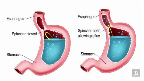 What Is A Hiatal Hernia YouTube