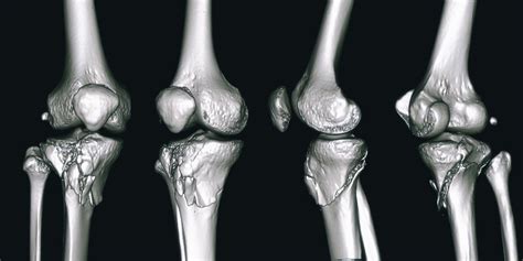 Proximal Tibial Plateau Fracture