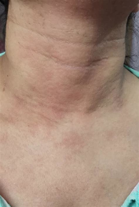 25 Weeks 5 Days Preg Woman With Itching And Rashes On Neck Chest Abd