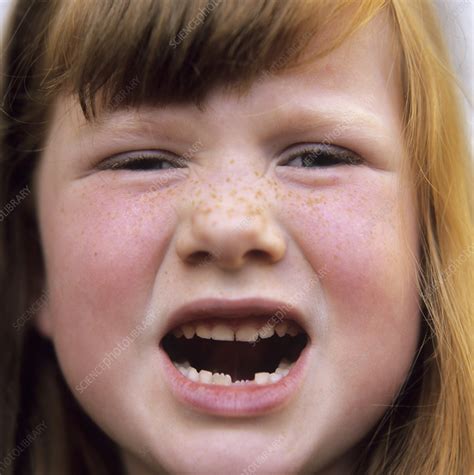 Loss Of Milk Teeth Stock Image P4860094 Science Photo Library