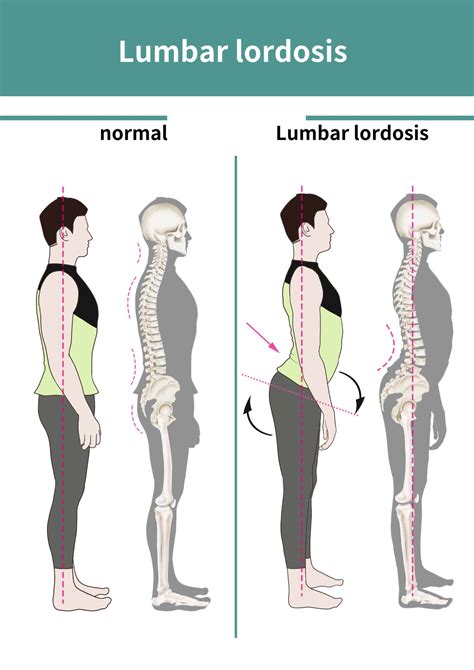 Lordosis Treatment Before After