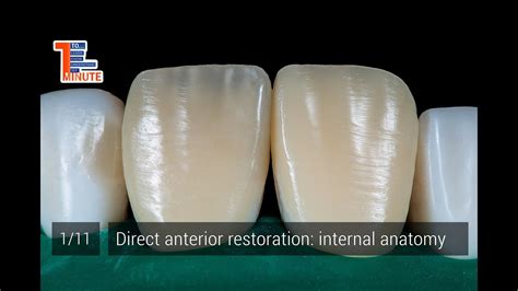 Direct Anterior Restoration Internal Anatomy Youtube