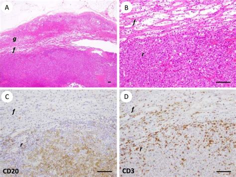 Representative Pathological Findings Of Primary Adrenal Diffuse Large