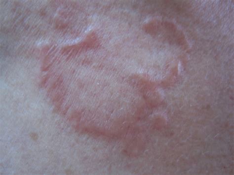 Annular Erythematous Papules In The Neckline