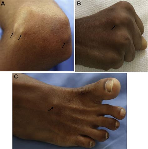 Subcutaneous Nodules In Acute Rheumatic Fever The Journal Of Pediatrics