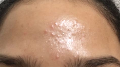 Small Bumps Over Forehead Read More General Acne Discussion By