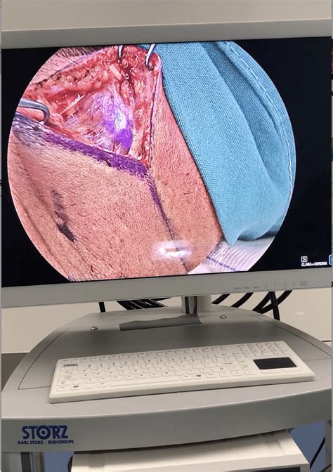 Intraoperative Icga To Identify The Sentinel Lymph Node Of The Neck