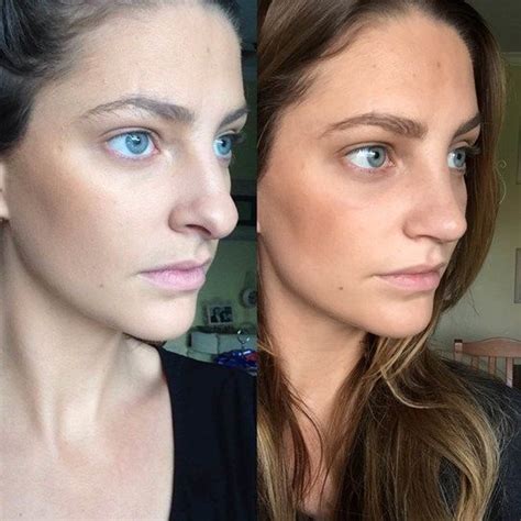 This Blogger Documented Her Nose Job Image 7 Job Images Rhinoplasty