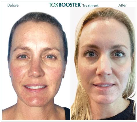 Toxbooster Combine Botox And The Vi Peel Smooth Synergy Medical Spa