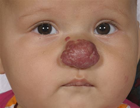 A 3 Month Old Infant With A “strawberry” Red Mass On Her Nose The Bmj
