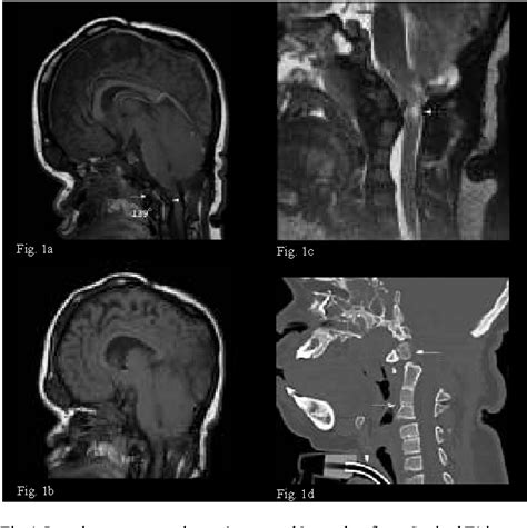 Figure 1 From Findings Of Chronic Subluxation Of The Os Odontoideum And