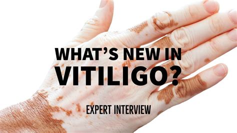 Whats New In Vitiligo Treatment Youtube