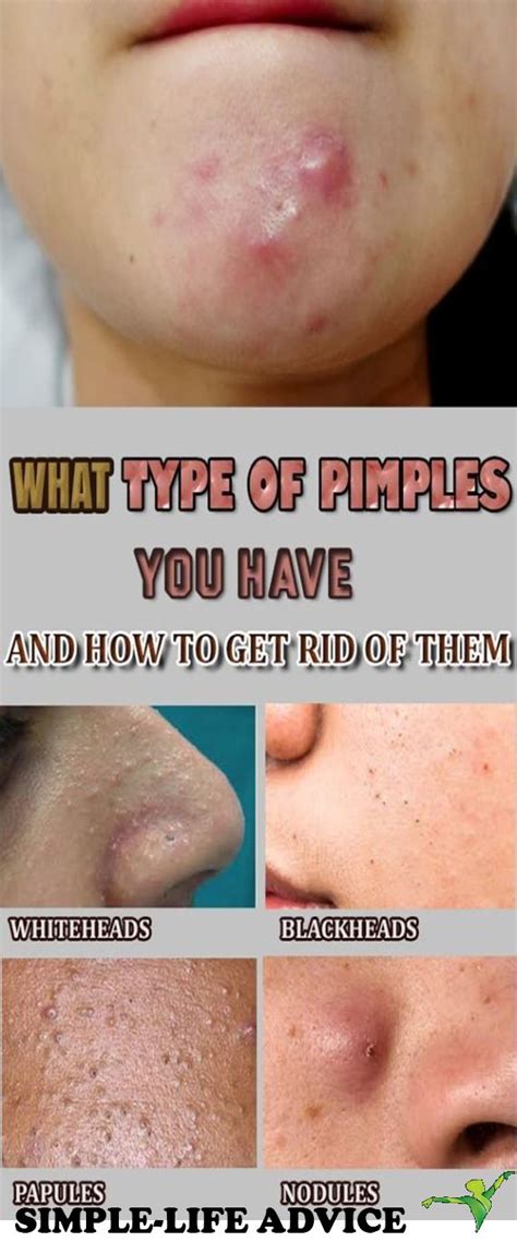 Pimple Like Bump On Nose