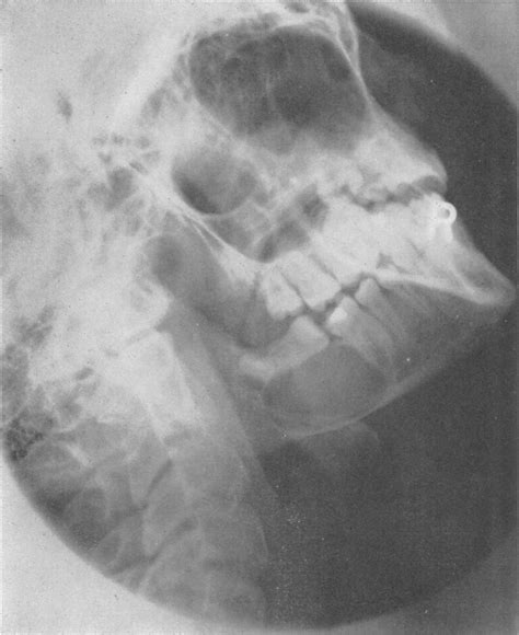 Multiple Nevoid Basal Cell Epithelioma Jaw Cysts And Bifid Rib — A