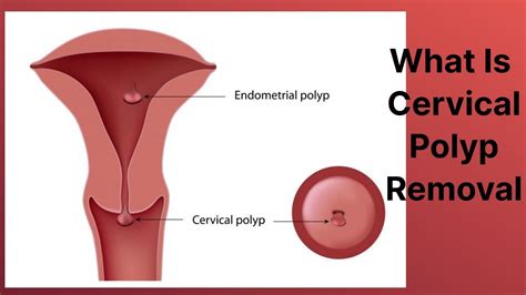 What Is Cervical Polyp Removal Youtube