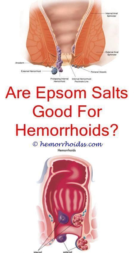 Hemorrhoids Could Be Really Uneasy And Also Distressing If You Have