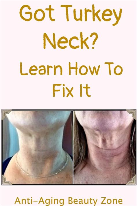 Get Rid Of Turkey Neck Neck Tightening Exercises That Work Tighten