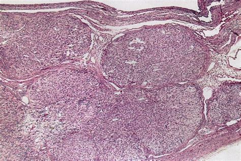 Pathology Outlines Granulosa Cell Tumor Juvenile