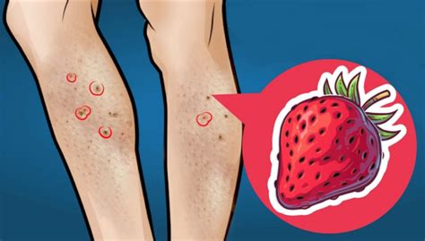 Strawberry Legs Causes And Home Remedies To Get Rid Of Them Ahealthguide