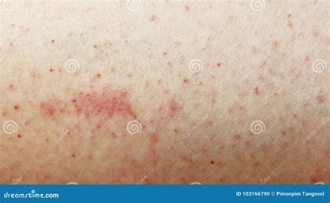 Rash On Sensitive Skin Stock Photo Image Of Dermatology 103166790