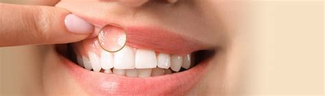 White Gums Symptoms Causes And Treatment Dentakay