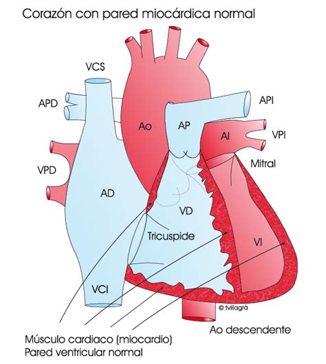 Miocardiopatía Arritmogénica La Web De Las Cardiopatías Congénitas
