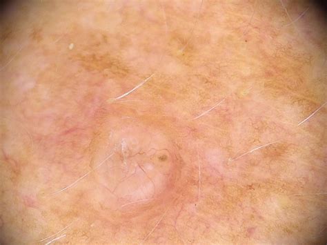 Basal Cell Carcinoma • Victoria Skin Cancer Screening And Early Diagnosis