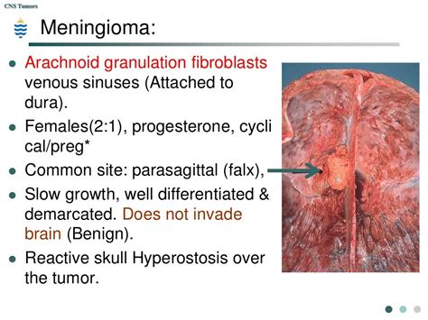 Pathology Of Cns Tumors