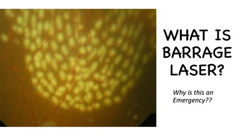 Barrage Laser For Retinal Holes Is It Safe Youtube