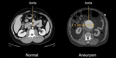 Abdominal Ct Aortic Aneurysm Litfl Radiology Library