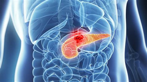 Australian Researchers Find Pancreatic Cancer Is Four