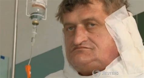 Slovakian Man Gets 13 Pound Tumor Removed From His Face After Decade Of