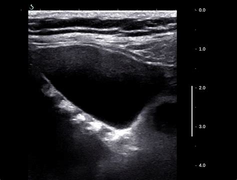 Vietnamese Medic Ultrasound Case Parathyroid Cyst Dr Phan Thanh