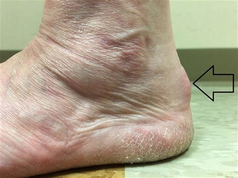 What Is That Lump On The Back Of My Heel Foot Right Podiatry Atelier Yuwa Ciao Jp