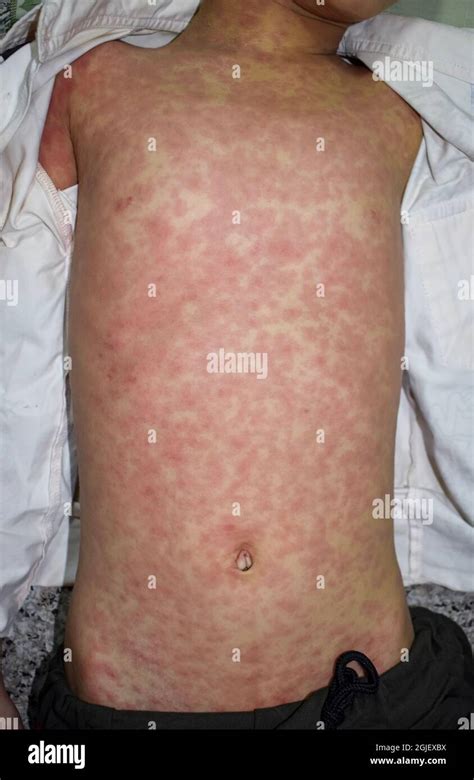 Child Rash Hi Res Stock Photography And Images Alamy